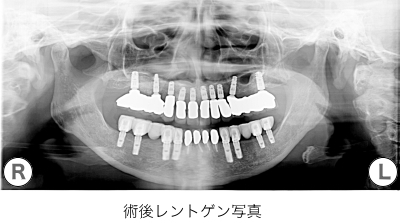 レントゲン